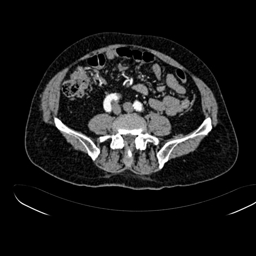 Abdominal aortic aneurysm (Radiopaedia 75131-86203 Axial C+ arterial phase 30).jpg