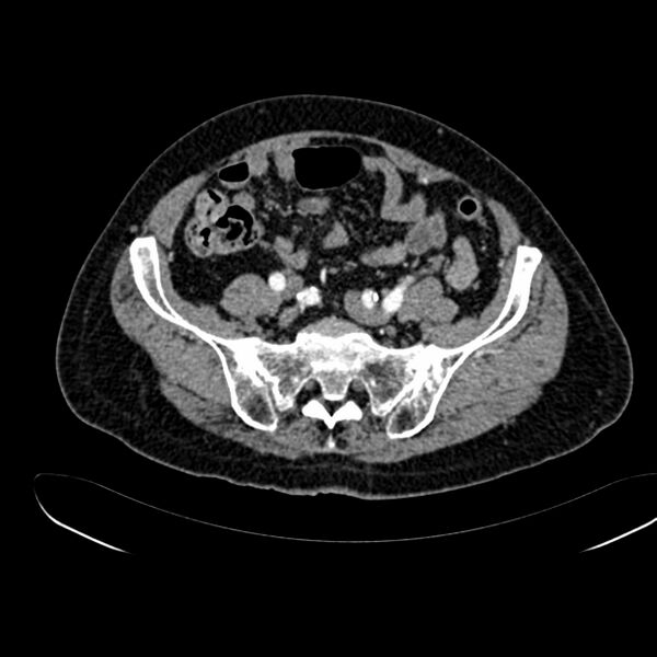 File:Abdominal aortic aneurysm (Radiopaedia 75131-86203 Axial C+ arterial phase 35).jpg