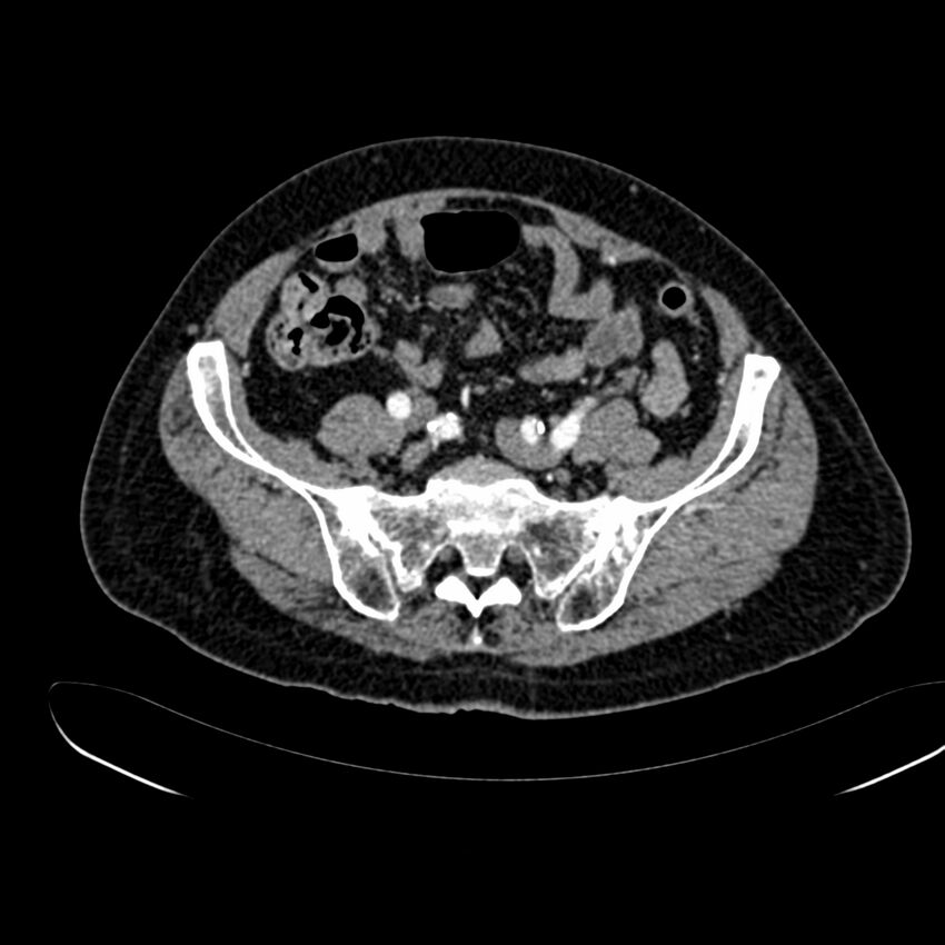Abdominal aortic aneurysm (Radiopaedia 75131-86203 Axial C+ arterial phase 35).jpg