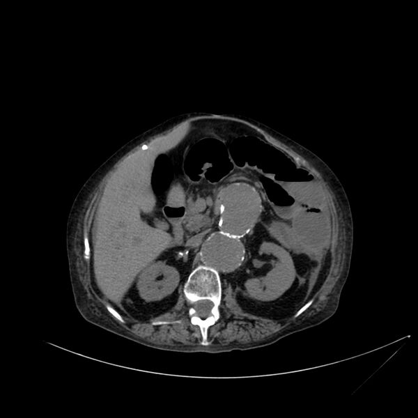 File:Abdominal aortic aneurysm - impending rupture (Radiopaedia 19233-19246 Axial non-contrast 49).jpg