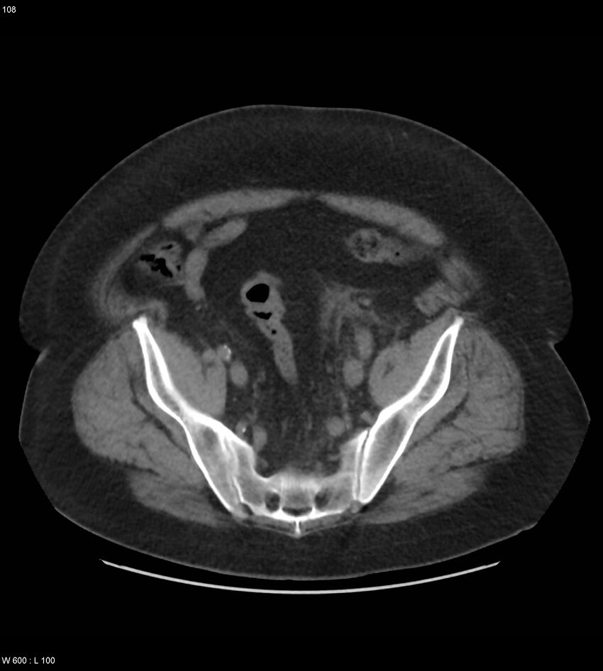 Abdominal aortic aneurysm with intramural hematoma then rupture (Radiopaedia 50278-55631 Axial non-contrast 104).jpg