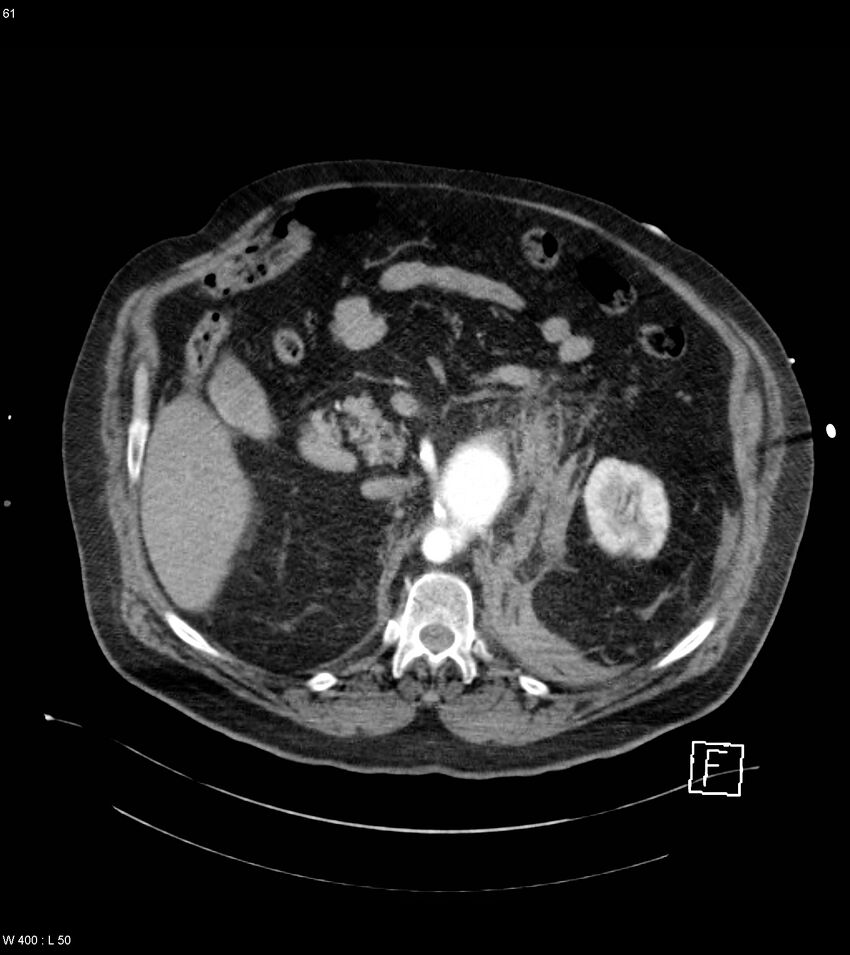 Abdominal aortic aneurysm with intramural hematoma then rupture (Radiopaedia 50278-55632 Axial C+ arterial phase 60).jpg