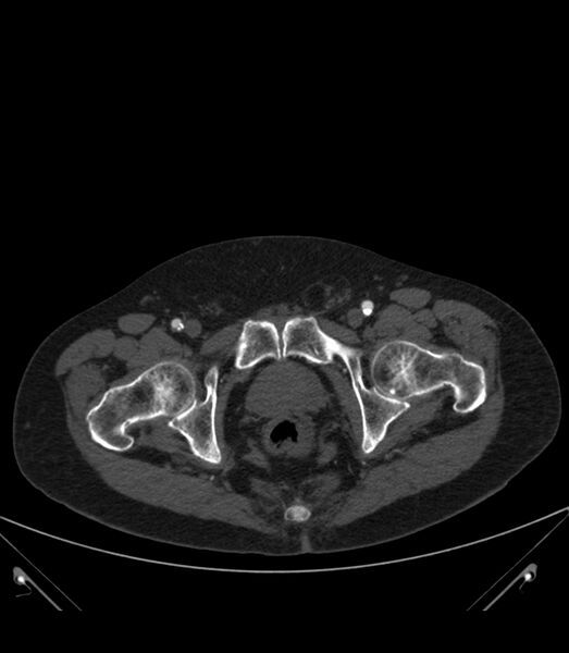 File:Abdominal aortic aneurysm with thrombus fissuration (Radiopaedia 46218-50618 Axial C+ arterial phase 44).jpg