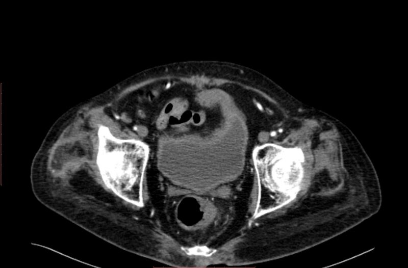 File:Abdominal aortic interposition tube graft and aneurysm thrombosis (Radiopaedia 71438-81857 Axial C+ arterial phase 216).jpg