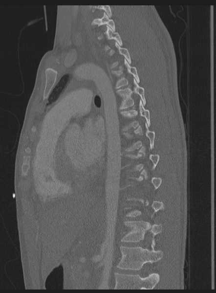 File:Abdominal multi-trauma - devascularised kidney and liver, spleen and pancreatic lacerations (Radiopaedia 34984-36486 Sagittal bone window 24).png