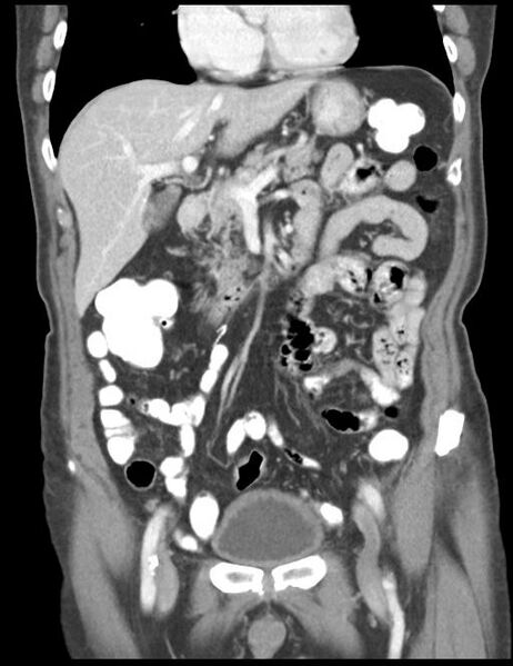 File:Abdominal wall metastasis from colorectal carcinoma (Radiopaedia 31016-31717 Coronal C+ portal venous phase 19).jpg