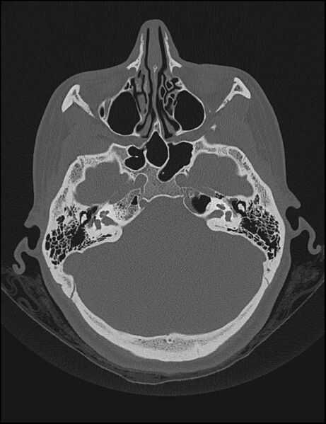 File:Aberrant right internal carotid artery (Radiopaedia 65191-74198 Axial non-contrast 45).jpg