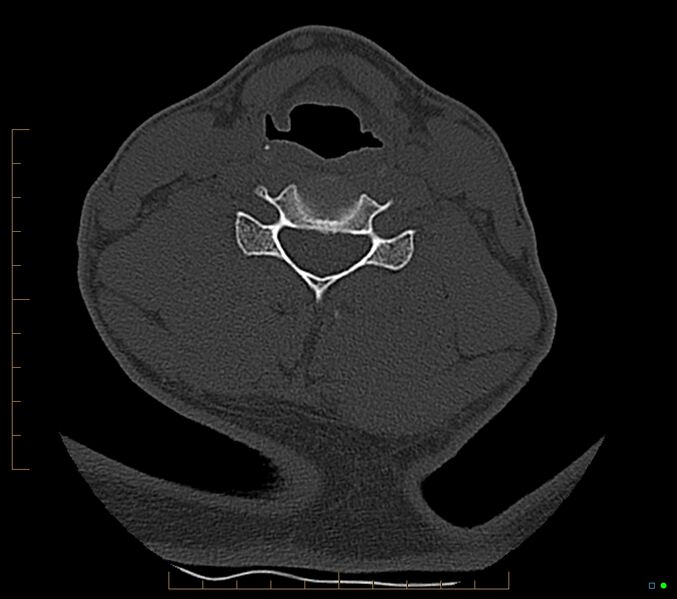 File:Accessory articulation of cervical transverse processes (Radiopaedia 82715-96933 Axial non-contrast 81).jpg