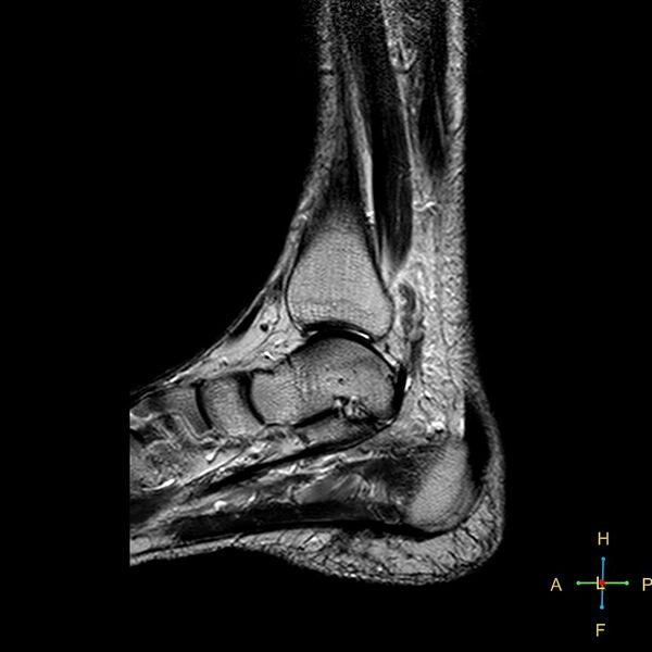 File:Achilles tendon complete tear (Radiopaedia 22834-22854 Sagittal T2 12).jpg