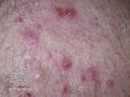 Acne affecting the back images (DermNet NZ acne-acne-back-190).jpg