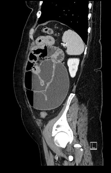 File:Active Crohn disease (Radiopaedia 59394-66750 Sagittal C+ portal venous phase 13).jpg