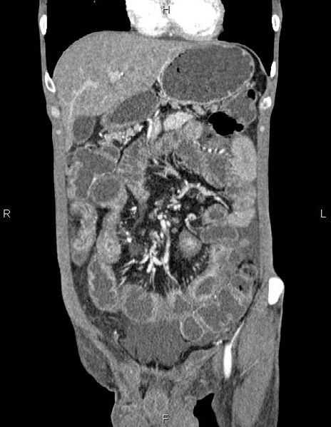 File:Active crohn disease (Radiopaedia 87133-103397 Coronal C+ arterial phase 17).jpg