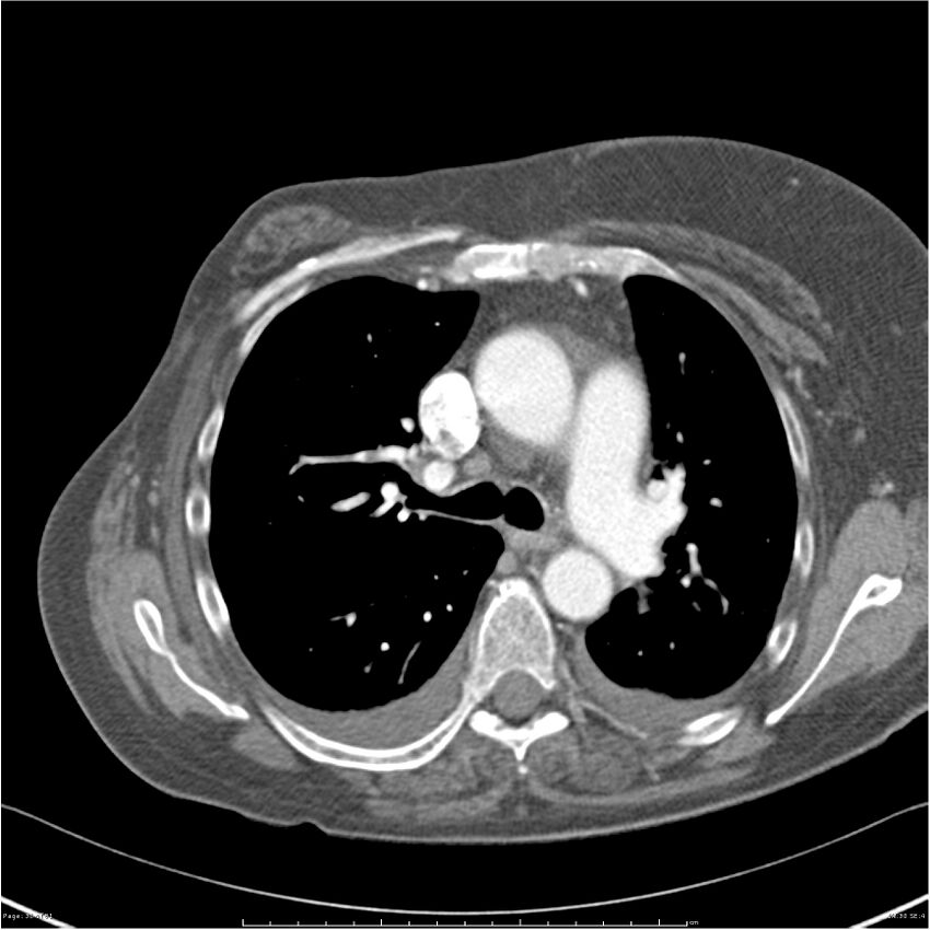 Acute-on-chronic pulmonary emboli (Radiopaedia 27925-28169 C+ CTPA 30).jpg