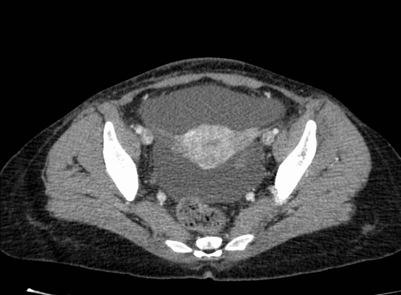 File:Acute Budd-Chiari syndrome (Radiopaedia 60858-68638 Axial C+ portal venous phase 257).jpg