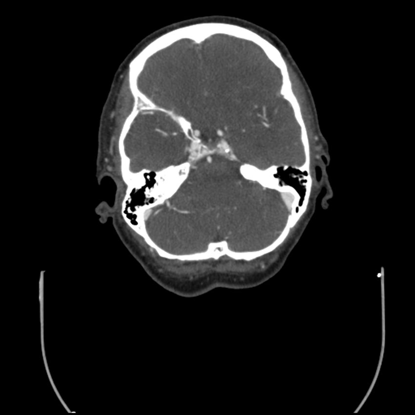 Acute M1 occlusion with ischemic penumbra (CT perfusion) (Radiopaedia 71897-82344 Axial C+ arterial phase thins 107).jpg