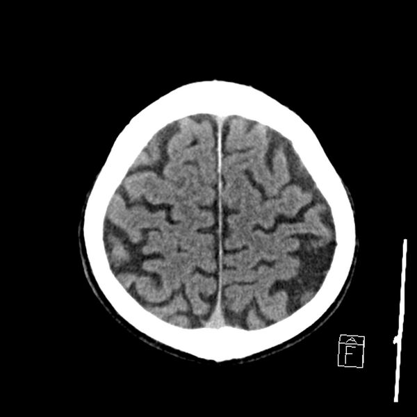 File:Acute P1 occlusion with PCA ischemia penumbra (CT perfusion) (Radiopaedia 72084-82586 Axial non-contrast 38).jpg