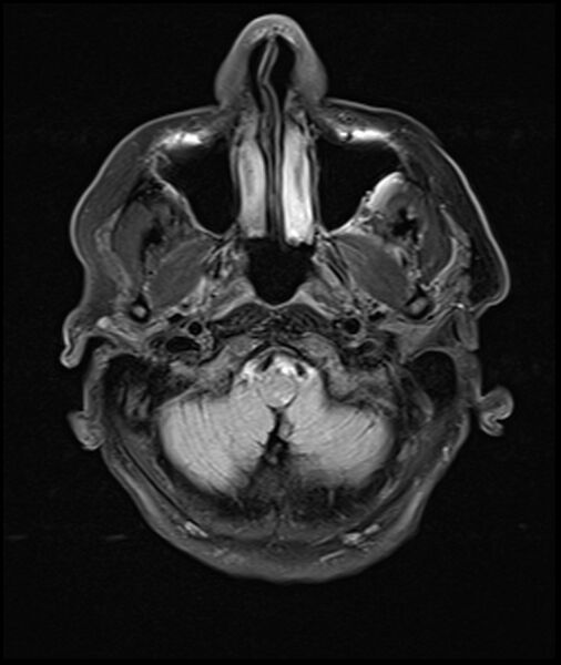 File:Acute P1 occlusion with PCA ischemia penumbra (CT perfusion) (Radiopaedia 72084-82590 Axial FLAIR 3).jpg