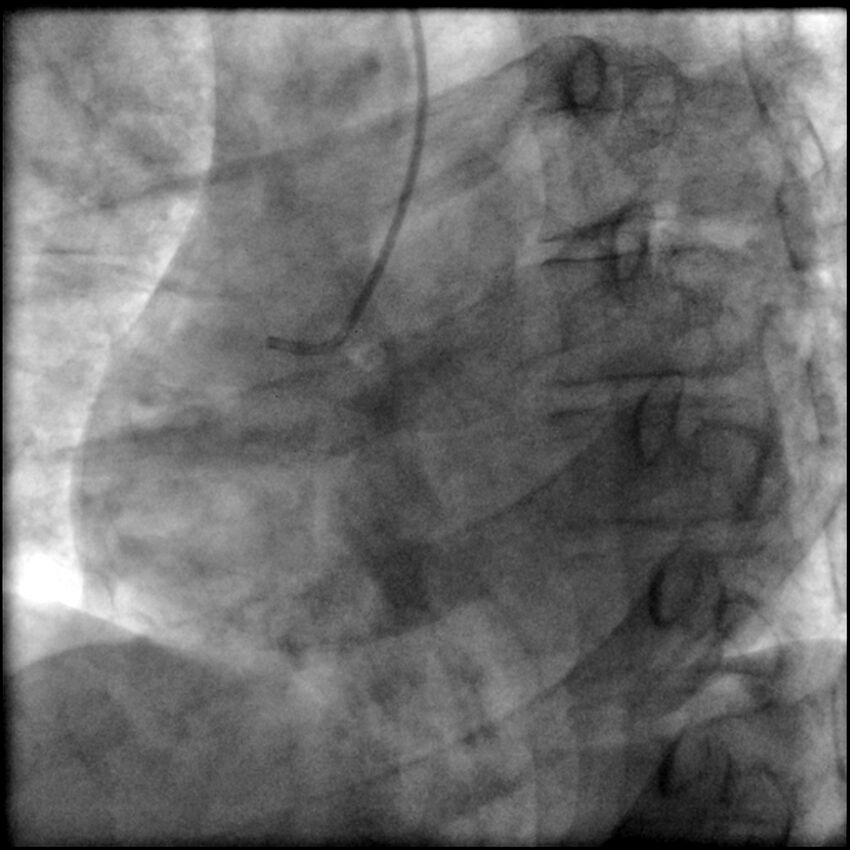 Acute anteroseptal myocardial infarction (Radiopaedia 68409-77946 RAO straight RCA 2).jpg