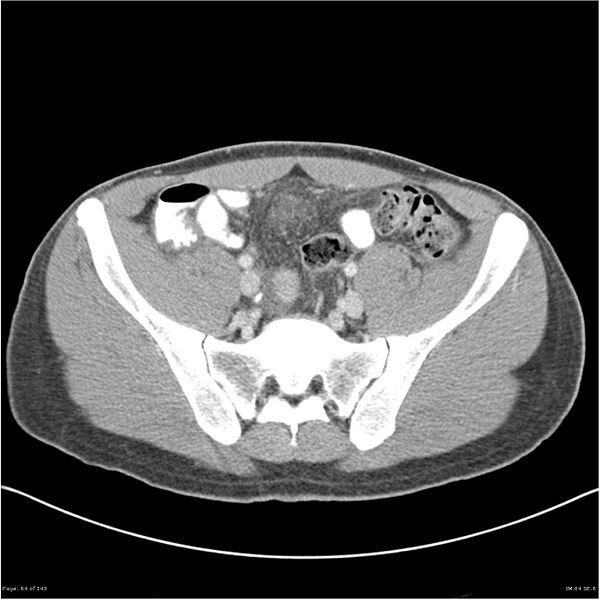 File:Acute appendicitis (Radiopaedia 25364-25615 B 54).jpg