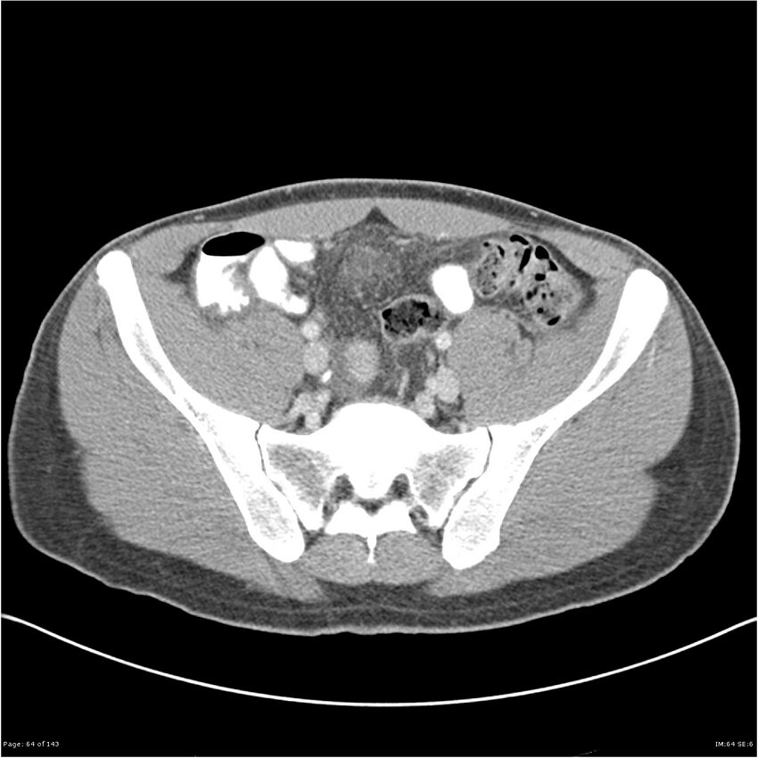 Acute appendicitis (Radiopaedia 25364-25615 B 54).jpg