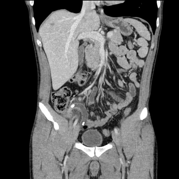 File:Acute appendicitis (Radiopaedia 27049-27227 Coronal C+ portal venous phase 22).jpg