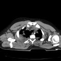 Acute aspiration pneumonitis (Radiopaedia 33605-34703 Axial non-contrast 24).jpg