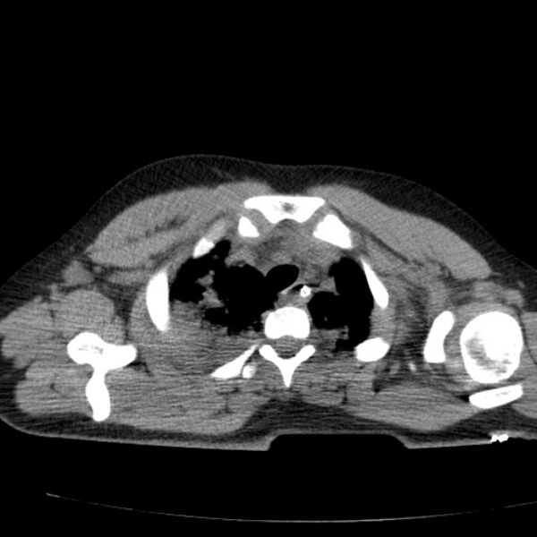 File:Acute aspiration pneumonitis (Radiopaedia 33605-34703 Axial non-contrast 24).jpg