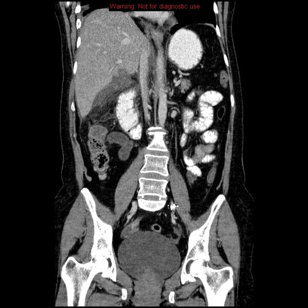 File:Acute gangrenous cholecystitis (Radiopaedia 10123-10661 Coronal C+ portal venous phase 21).jpg