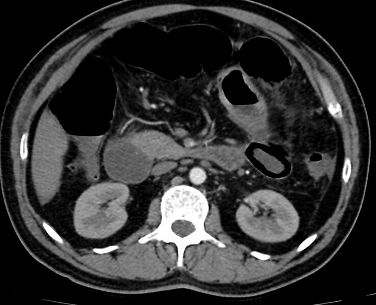 File:Acute mesenteric ischemia - superior mesenteric artery thrombosis (Radiopaedia 73947-84776 Axial C+ arterial phase 40).jpg
