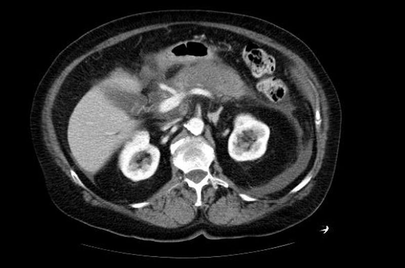 File:Acute pancreatitis (Radiopaedia 11163-11528 Axial 2).jpg