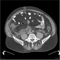 Acute pancreatitis (Radiopaedia 19135-19116 Axial non-contrast 40).jpg