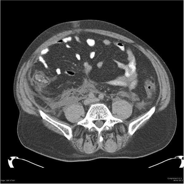 File:Acute pancreatitis (Radiopaedia 19135-19116 Axial non-contrast 40).jpg