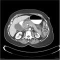 Acute pancreatitis (Radiopaedia 19136-19117 Axial C+ portal venous phase 14).jpg