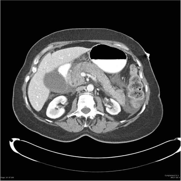 File:Acute pancreatitis (Radiopaedia 19136-19117 Axial C+ portal venous phase 14).jpg