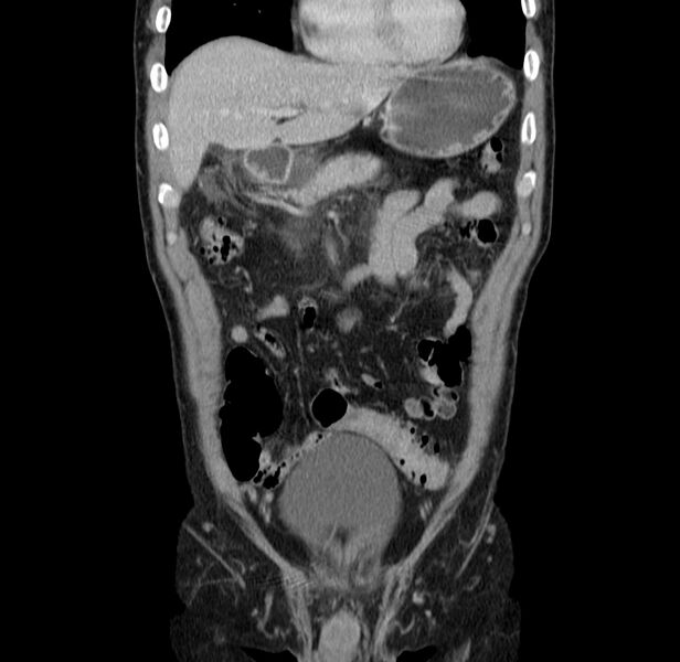File:Acute pancreatitis (Radiopaedia 22572-22596 Coronal C+ portal venous phase 16).jpg