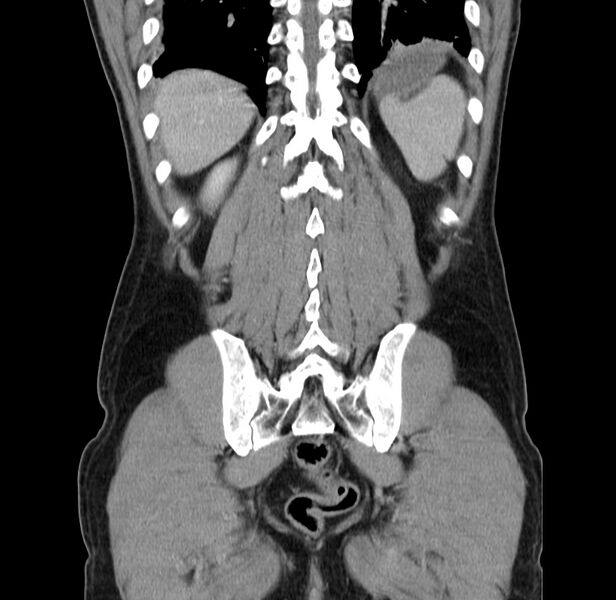 File:Acute pancreatitis (Radiopaedia 22572-22596 Coronal C+ portal venous phase 44).jpg