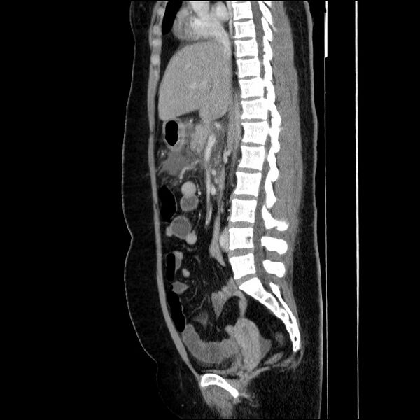 File:Acute pancreatitis (Radiopaedia 69236-79012 Sagittal C+ portal venous phase 54).jpg