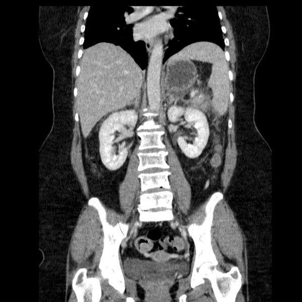 File:Acute pancreatitis - Balthazar C (Radiopaedia 26569-26714 Coronal C+ portal venous phase 42).jpg