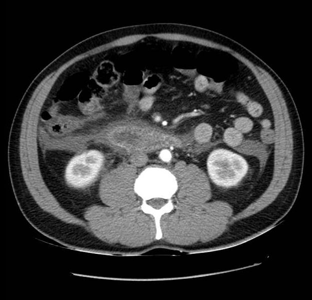 File:Acute pancreatitis - Balthazar E (Radiopaedia 23080-23110 Axial C+ arterial phase 36).jpg