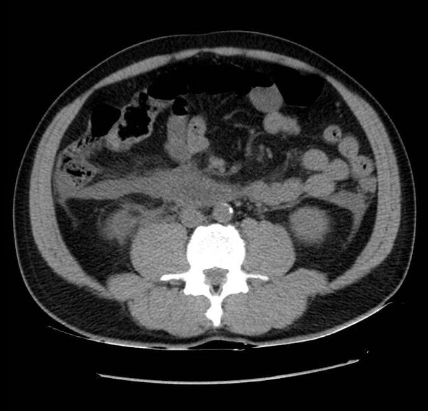 File:Acute pancreatitis - Balthazar E (Radiopaedia 23080-23110 Axial non-contrast 39).jpg
