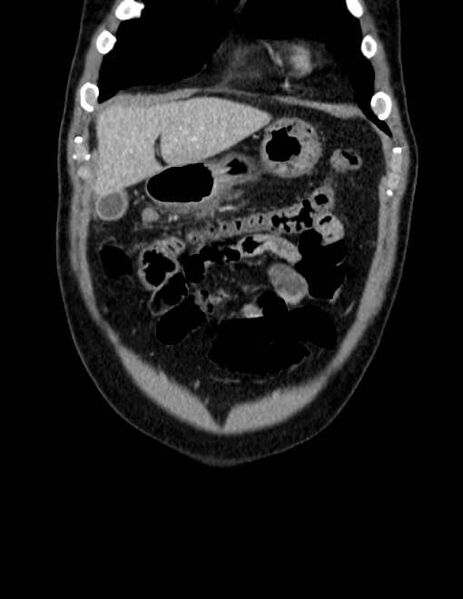 File:Acute pancreatitis - Balthazar E (Radiopaedia 23080-23110 Coronal C+ portal venous phase 11).jpg