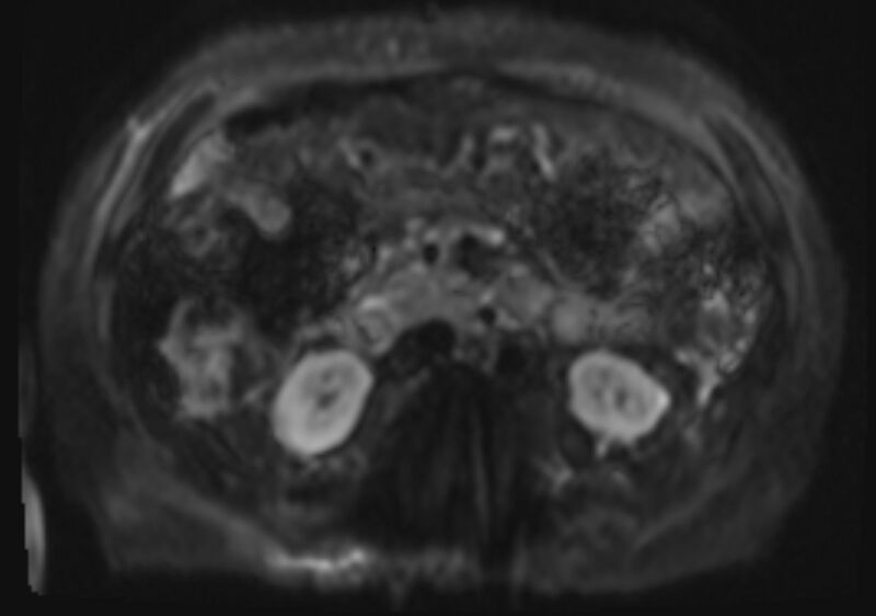File:Acute portal vein thrombosis (Radiopaedia 73198-83925 Axial DWI 23).jpg