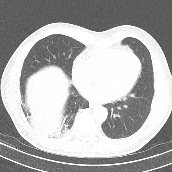 File:Acute pulmonary embolism (Radiopaedia 81677-95570 Axial lung window 32).jpg