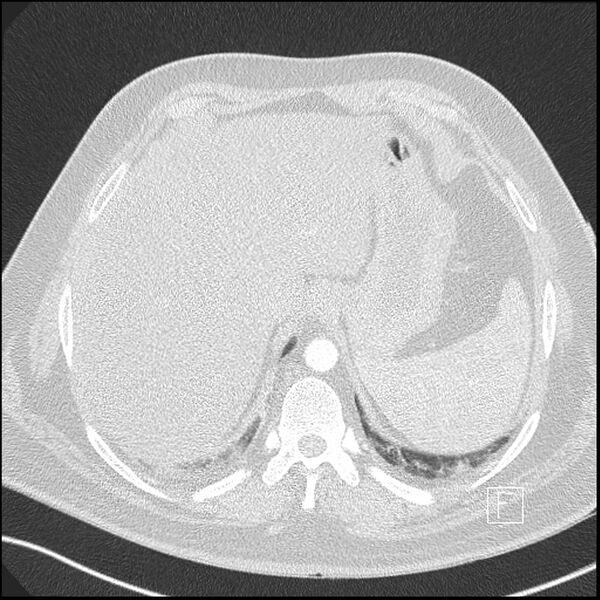 File:Acute pulmonary embolism with pulmonary infarct (Radiopaedia 73062-83768 Axial lung window 26).jpg