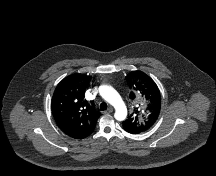 File:Acute pulmonary embolism with pulmonary infarcts (Radiopaedia 77688-89908 Axial C+ CTPA 15).jpg