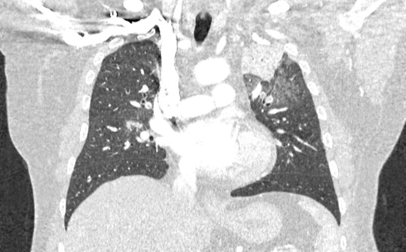 File:Acute pulmonary embolism with pulmonary infarcts (Radiopaedia 77688-89908 Coronal lung window 43).jpg