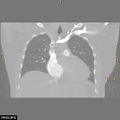 Acute reversible pulmonary hypertension and right heart failure from cocaine toxicity (Radiopaedia 49394-54517 Coronal C+ CTPA 17).jpg