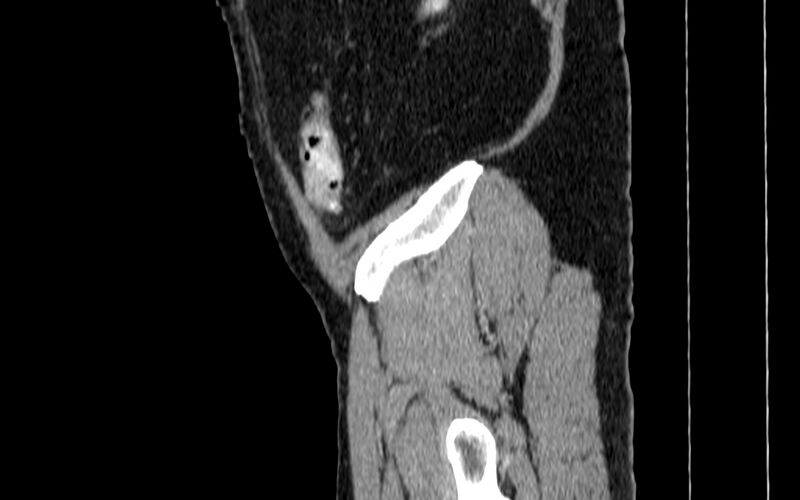 File:Acute sigmoid colon diverticulitis (Radiopaedia 55507-61976 Sagittal C+ portal venous phase 129).jpg