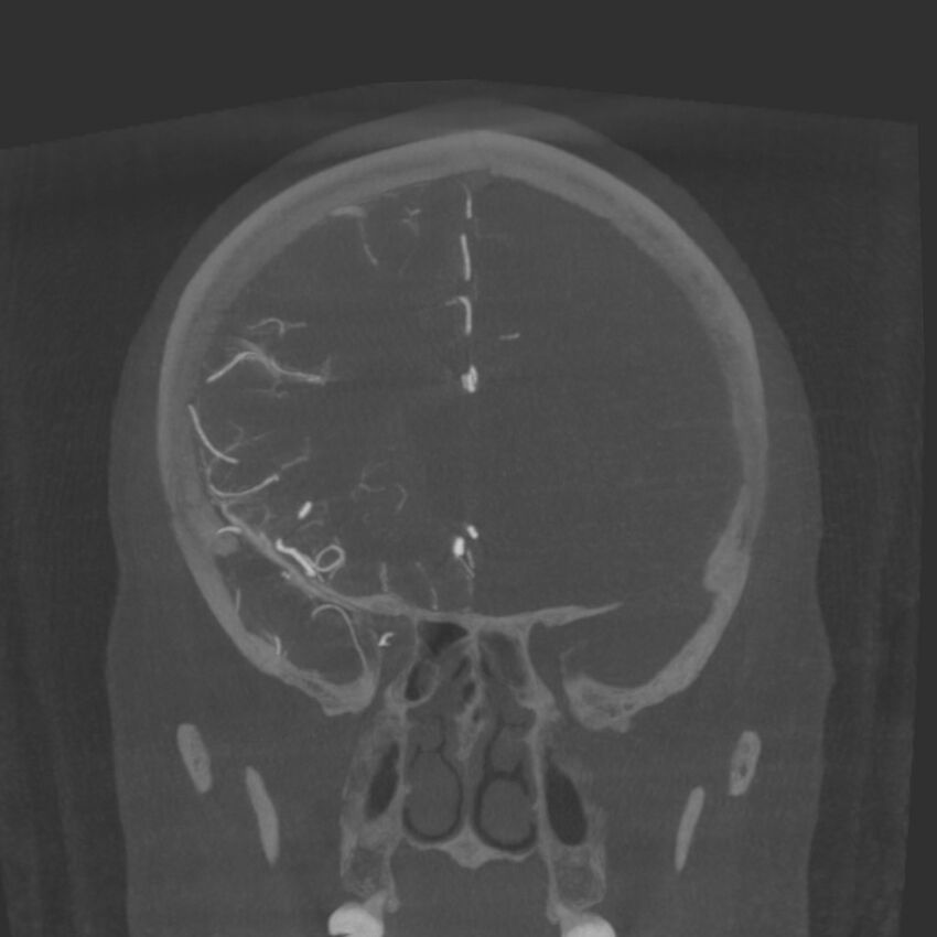 Acute subarachnoid hemorrhage and accessory anterior cerebral artery (Radiopaedia 69231-79010 Coronal arterial - MIP 34).jpg