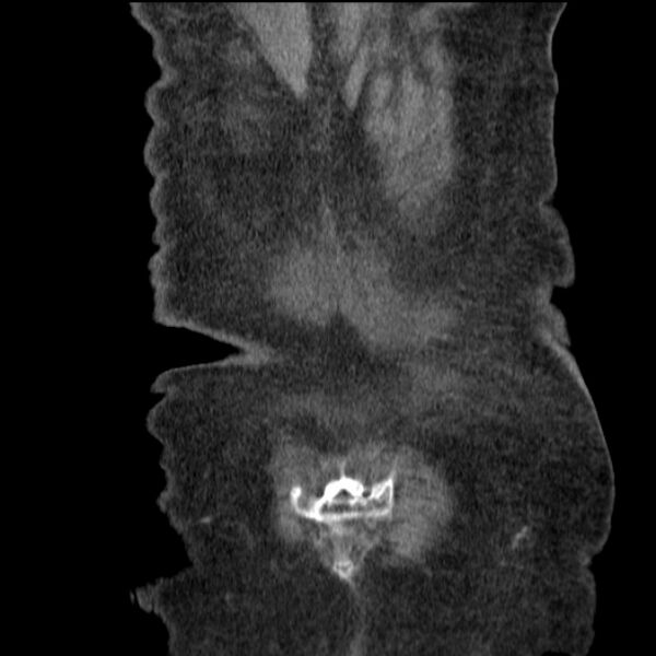 File:Acute tubular necrosis (Radiopaedia 28077-28334 G 77).jpg